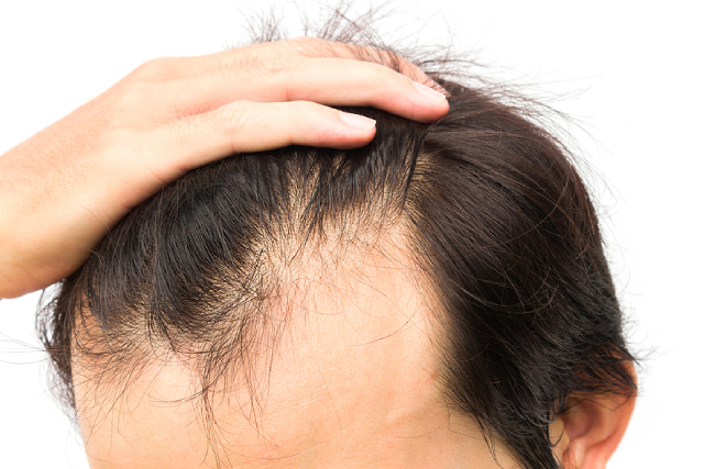 Understanding The Role Of Scalp Health In Hair Loss Prevention