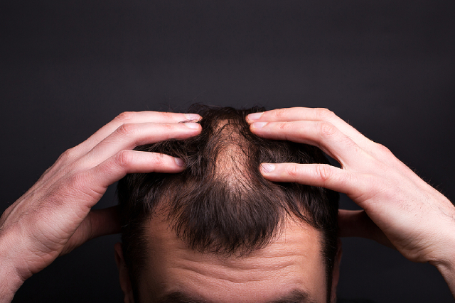 Do Hair Replacement Systems Work For Every Type of Baldness?