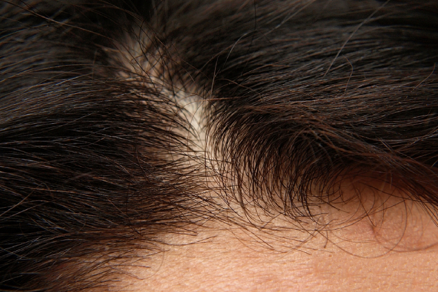 How Can You Tell If Your Hair Loss is Temporary or Permanent?