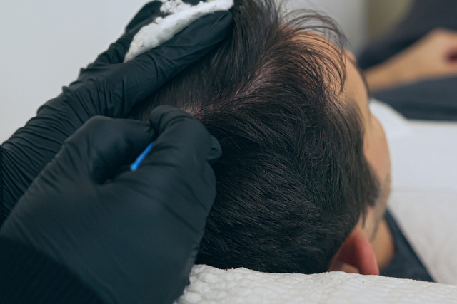 Scalp Micropigmentation vs. Hair Replacement Systems